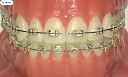 Clear bands braces