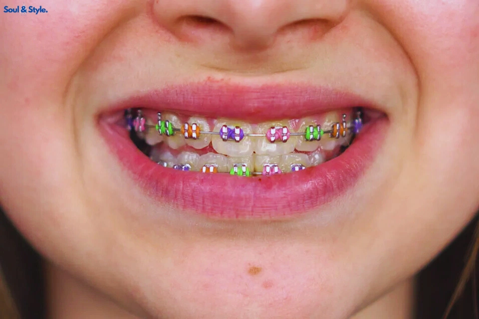 Neon Shades braces