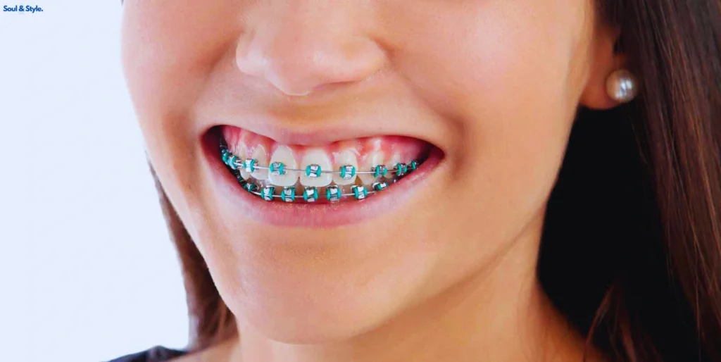 Teal or Turquoise braces