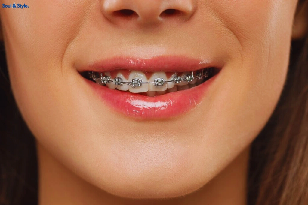 Silver or gray braces