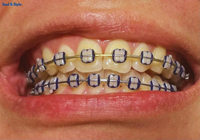 White braces
