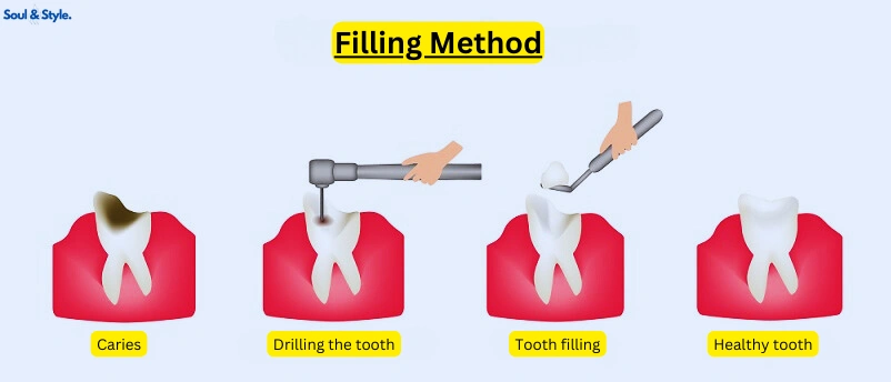 Fillings