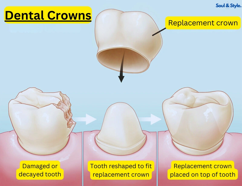 Crowns