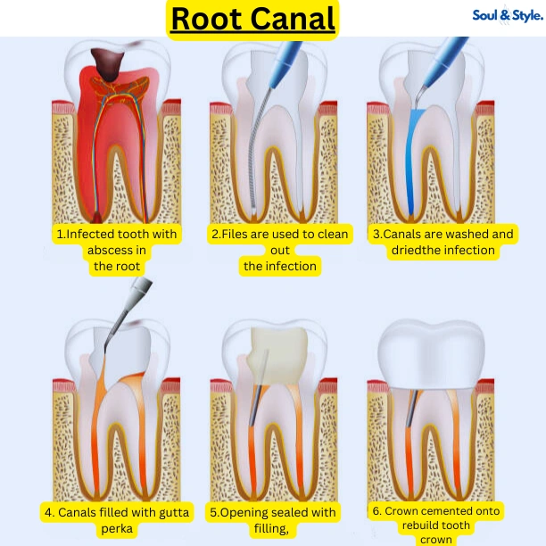 Root Canals