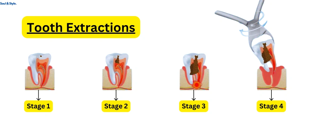 Tooth Extraction