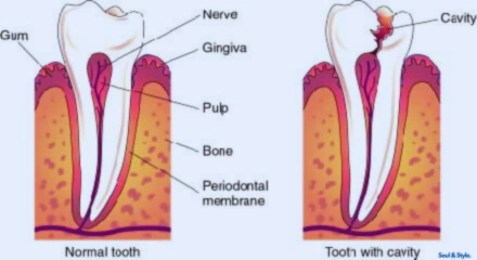 What Does a Cavity Look Like?