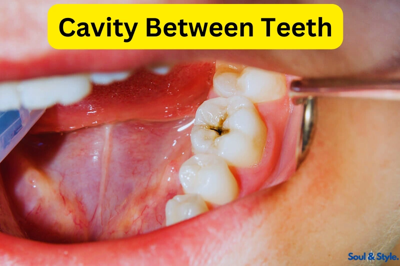 Cavity Between Teeth
