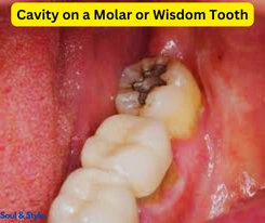 Cavity on a Molar or Wisdom Tooth
