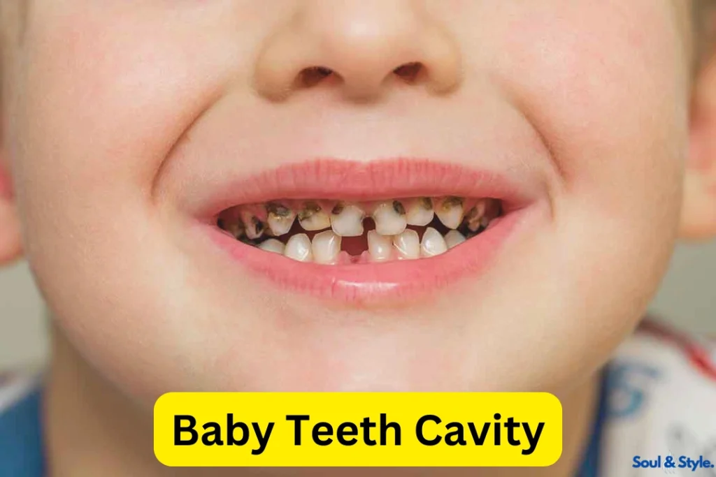 Baby Teeth Cavity