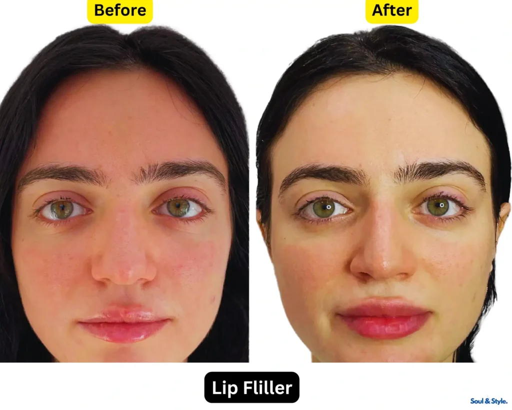 lip filler before and after