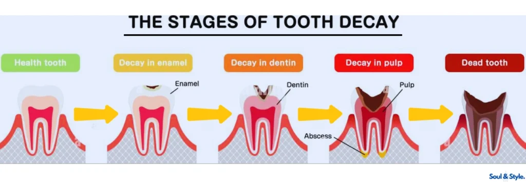 Stages of Tooth Decay and What They Look Like