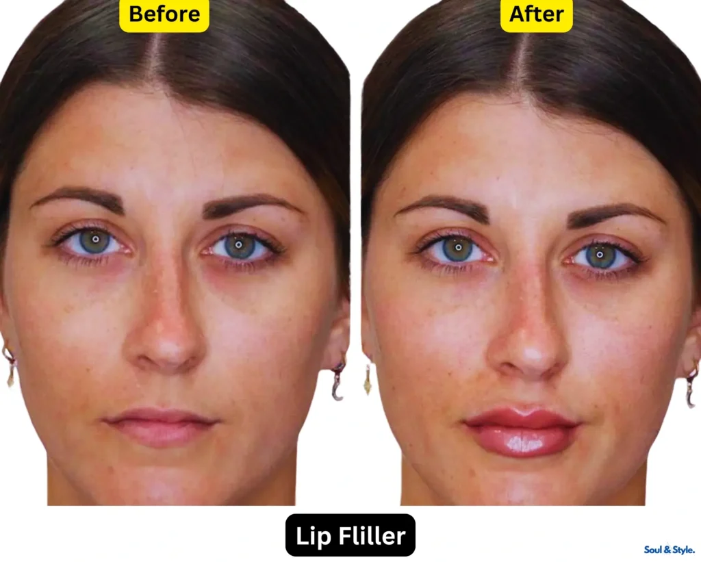 lip filler before and after